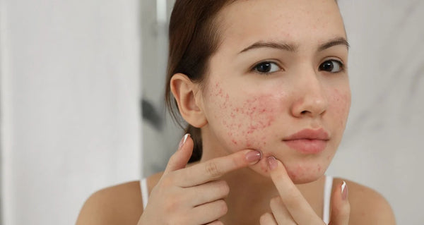 Acne & Blemishes