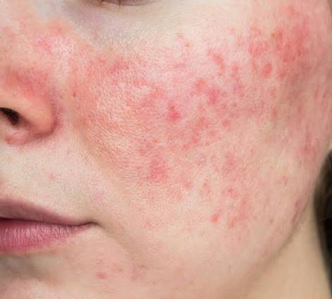 Sensitivity & Redness