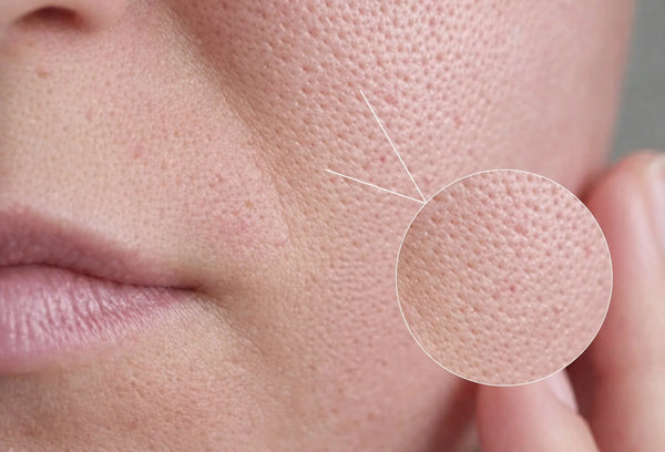 Oily & Large Pores